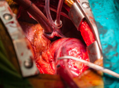 Operation am Herzen mit Instrumenten